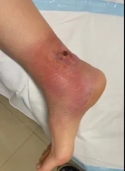 Photo of a patient with a buruli ulcer