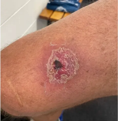 Photo of a patient with a buruli ulcer on upper leg
