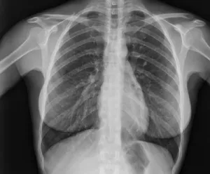 X-ray Xray